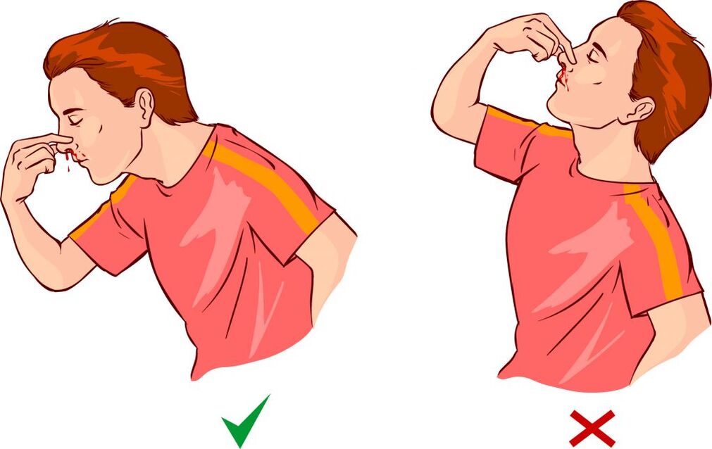 Epistaxe para hipertensão