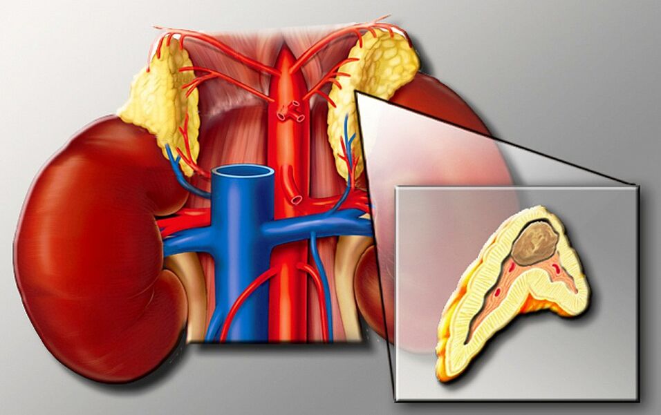 Feocromocitoma para hipertensão